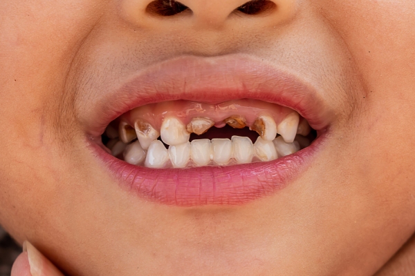 Dientes de chico con caries