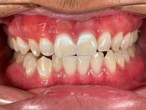 Fluorosis dental en incisivos centrales superiores