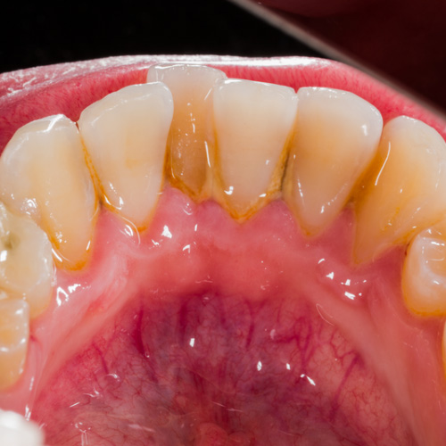 Acumulación de sarro y encías inflamadas en dientes inferiores