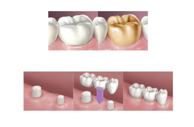 Proceso para colocar coronas
