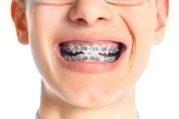 Niño sonrie con brackets