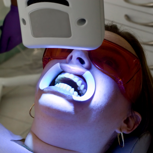 Mujer acostada en el consultorio dental recibiendo un tratamiento de blanqueamiento dental con luz, usando gafas de protección y separador bucal